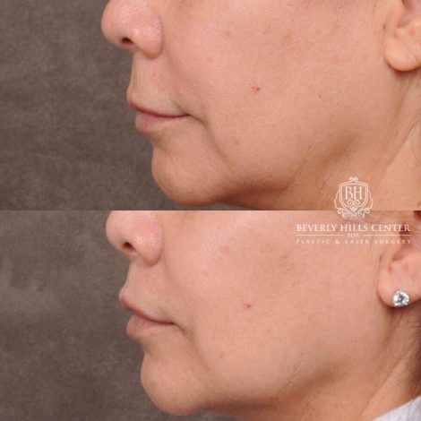 Beverly Hills Center Female Patient Before and After CUPID LIFT® Corner Lift