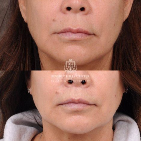 Beverly Hills Center Female Patient Before and After CUPID LIFT® Corner Lift