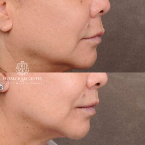 Beverly Hills Center Female Patient Before and After CUPID LIFT® Corner Lift