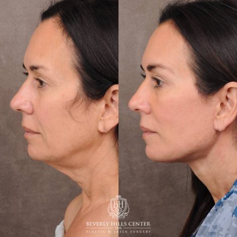 Beverly Hills Center Female Patient Before and After AuraLyft