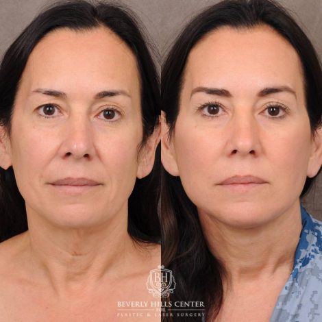 Beverly Hills Center Female Patient Before and After AuraLyft