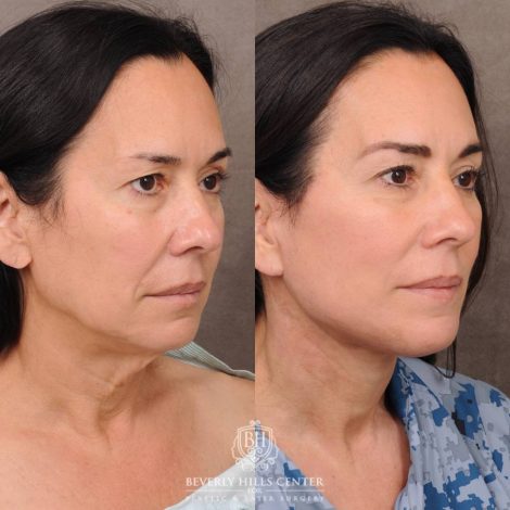 Beverly Hills Center Female Patient Before and After AuraLyft