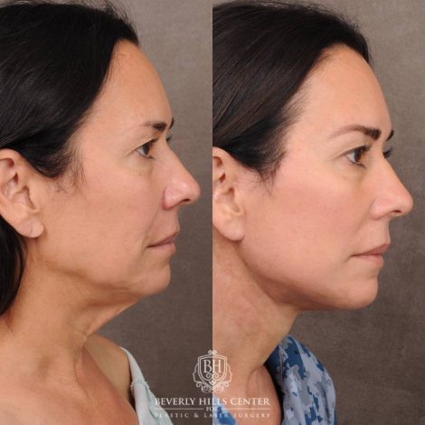 Beverly Hills Center Female Patient Before and After AuraLyft