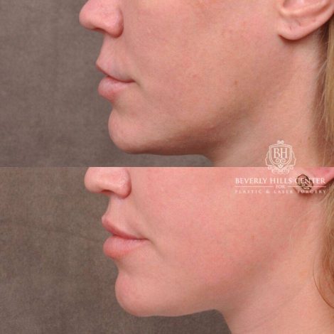 Beverly Hills Center Female Patient Before and After Upper Lip Lift
