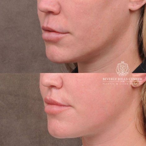 Beverly Hills Center Female Patient Before and After Upper Lip Lift