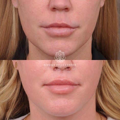 Beverly Hills Center Female Patient Before and After Upper Lip Lift
