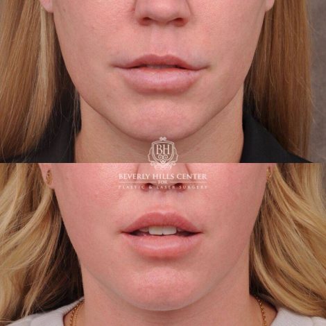 Beverly Hills Center Female Patient Before and After Upper Lip Lift