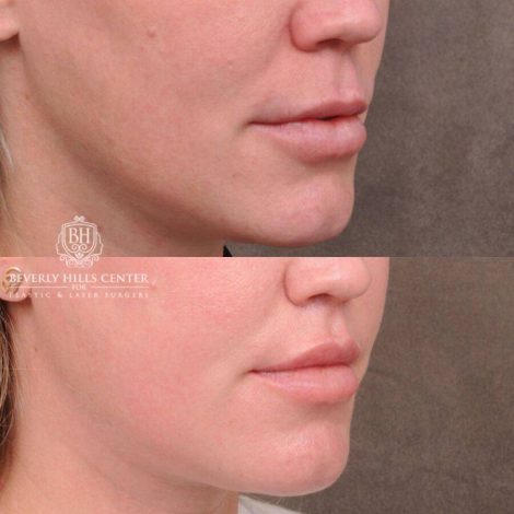 Beverly Hills Center Female Patient Before and After Upper Lip Lift
