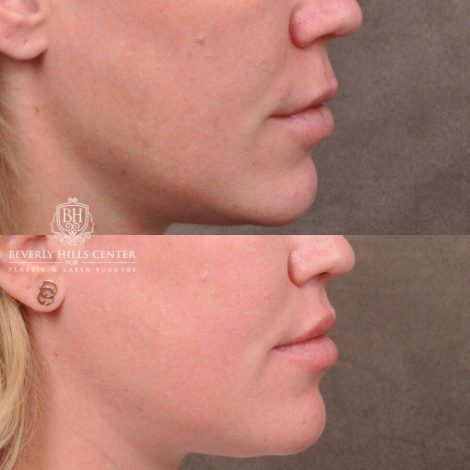 Beverly Hills Center Female Patient Before and After Upper Lip Lift