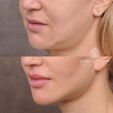 Beverly Hills Center Female Patient Before and After CUPID LIFT® Lip Lift