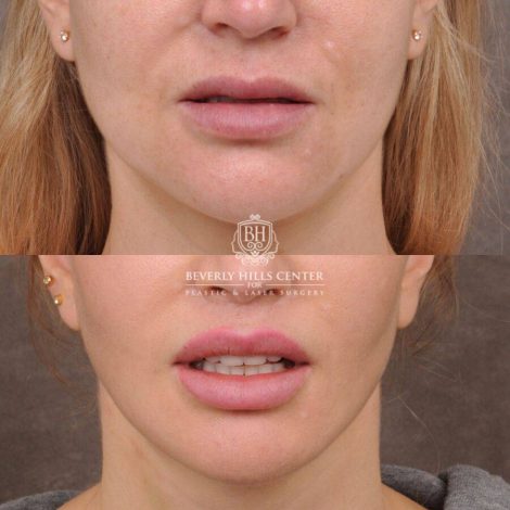 Beverly Hills Center Female Patient Before and After CUPID LIFT® Lip Lift