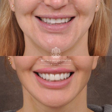 Beverly Hills Center Female Patient Before and After CUPID LIFT® Lip Lift