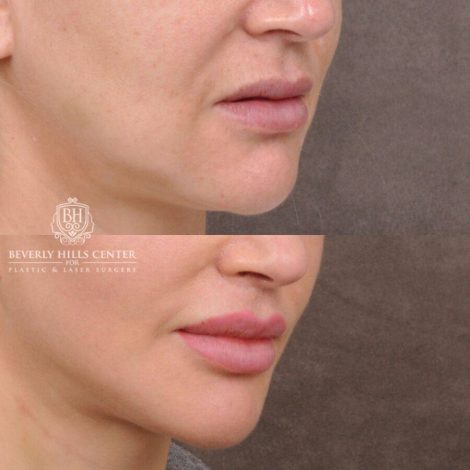 Beverly Hills Center Female Patient Before and After CUPID LIFT® Lip Lift