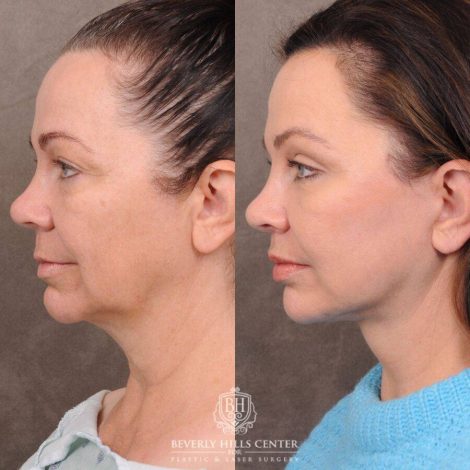 Beverly Hills Center Female Patient Before and After Comprehensive AuraLyft