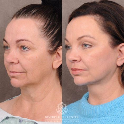 Beverly Hills Center Female Patient Before and After Comprehensive AuraLyft
