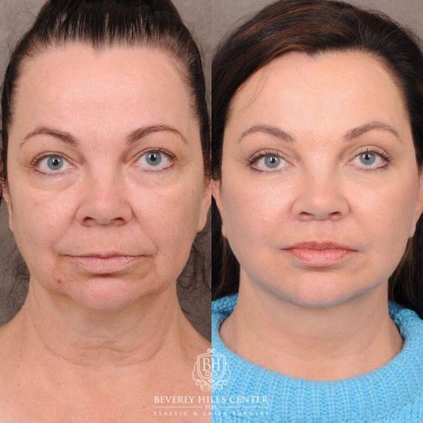 Beverly Hills Center Female Patient Before and After Comprehensive AuraLyft