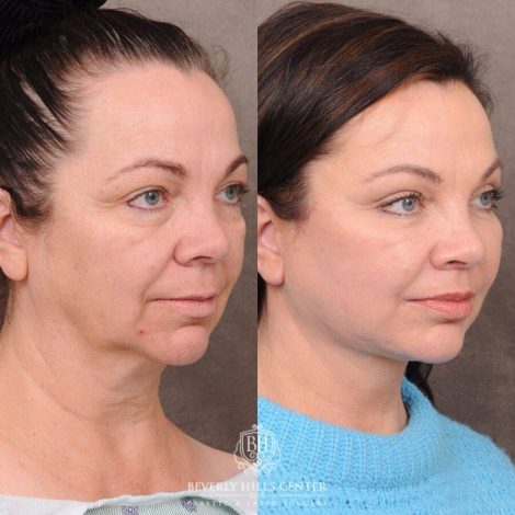 Beverly Hills Center Female Patient Before and After Comprehensive AuraLyft