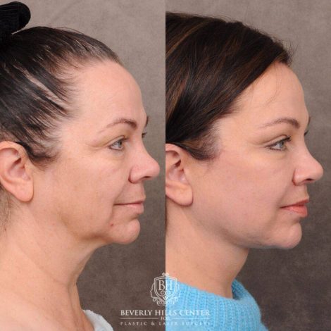 Beverly Hills Center Female Patient Before and After Comprehensive AuraLyft