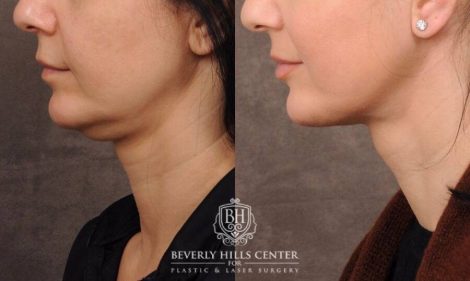 Beverly Hills Center Female Patient Before and After Weekend Neck Lift