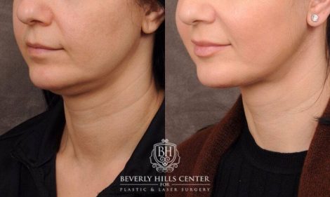 Beverly Hills Center Female Patient Before and After Weekend Neck Lift