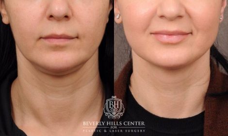 Beverly Hills Center Female Patient Before and After Weekend Neck Lift