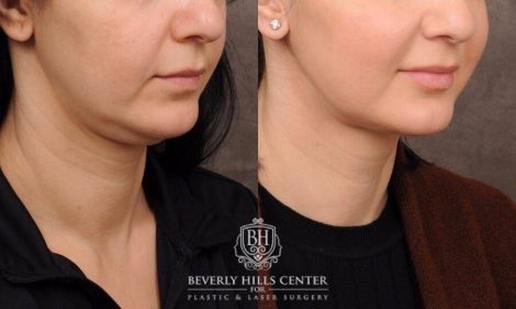 Beverly Hills Center Female Patient Before and After Weekend Neck Lift