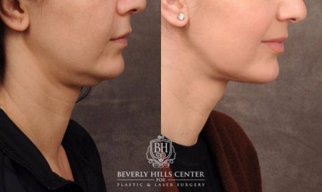 Beverly Hills Center Female Patient Before and After Weekend Neck Lift