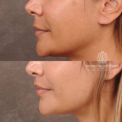 Beverly Hills Center Female Patient Before and After CUPID LIFT® Lip Lift