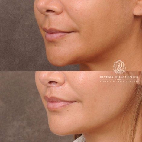 Beverly Hills Center Female Patient Before and After CUPID LIFT® Lip Lift