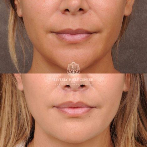 Beverly Hills Center Female Patient Before and After CUPID LIFT® Lip Lift