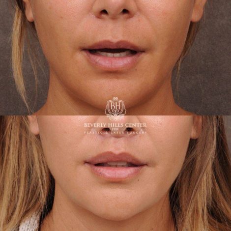 Beverly Hills Center Female Patient Before and After CUPID LIFT® Lip Lift