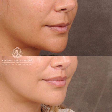 Beverly Hills Center Female Patient Before and After CUPID LIFT® Lip Lift