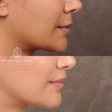 Beverly Hills Center Female Patient Before and After CUPID LIFT® Lip Lift