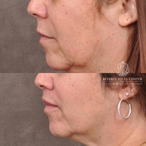 Beverly Hills Center Female Patient Before and After CUPID LIFT® Corner Lift Procedure