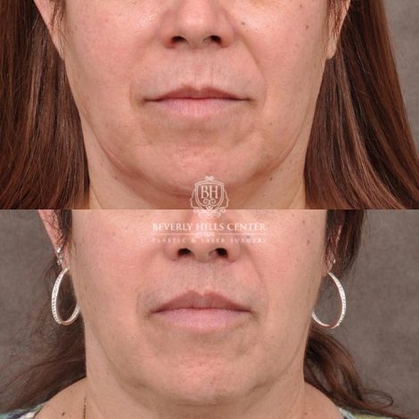 Beverly Hills Center Female Patient Before and After CUPID LIFT® Corner Lift Procedure