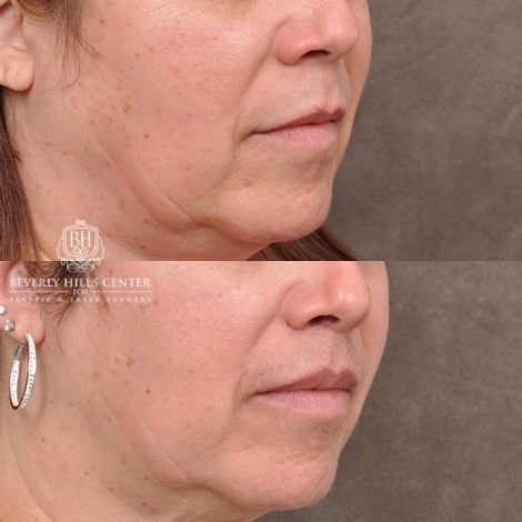 Beverly Hills Center Female Patient Before and After CUPID LIFT® Corner Lift Procedure