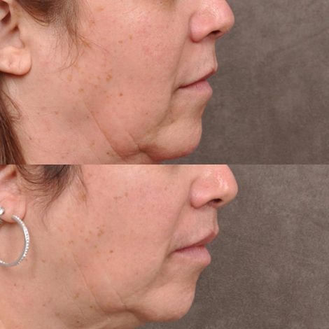 Beverly Hills Center Female Patient Before and After CUPID LIFT® Corner Lift Procedure