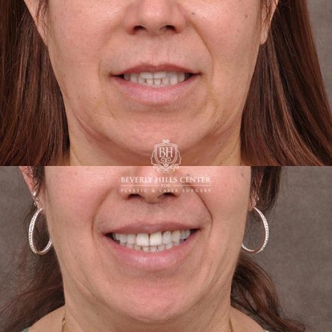 Beverly Hills Center Female Patient Before and After CUPID LIFT® Corner Lift Procedure