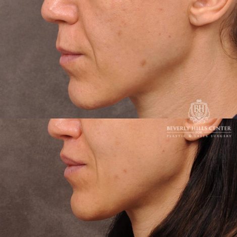 Beverly Hills Center Female Patient Before and After Revision Rhinoplasty, Lip Lift