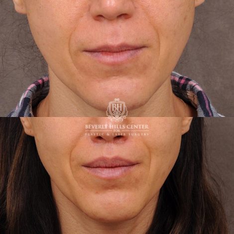 Beverly Hills Center Female Patient Before and After Revision Rhinoplasty, Lip Lift