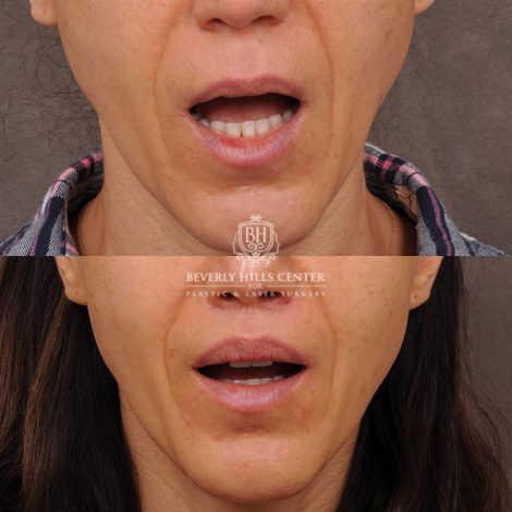 Beverly Hills Center Female Patient Before and After Revision Rhinoplasty, Lip Lift