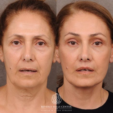 Beverly Hills Center Female Patient Before and After Comprehensive AuraLyft, Mini Brow Lift, CUPID LIFT® Lip Lift