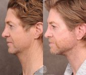 Beverly Hills Center Male Patient Before and After AuraLyft, Laryngeal Setback