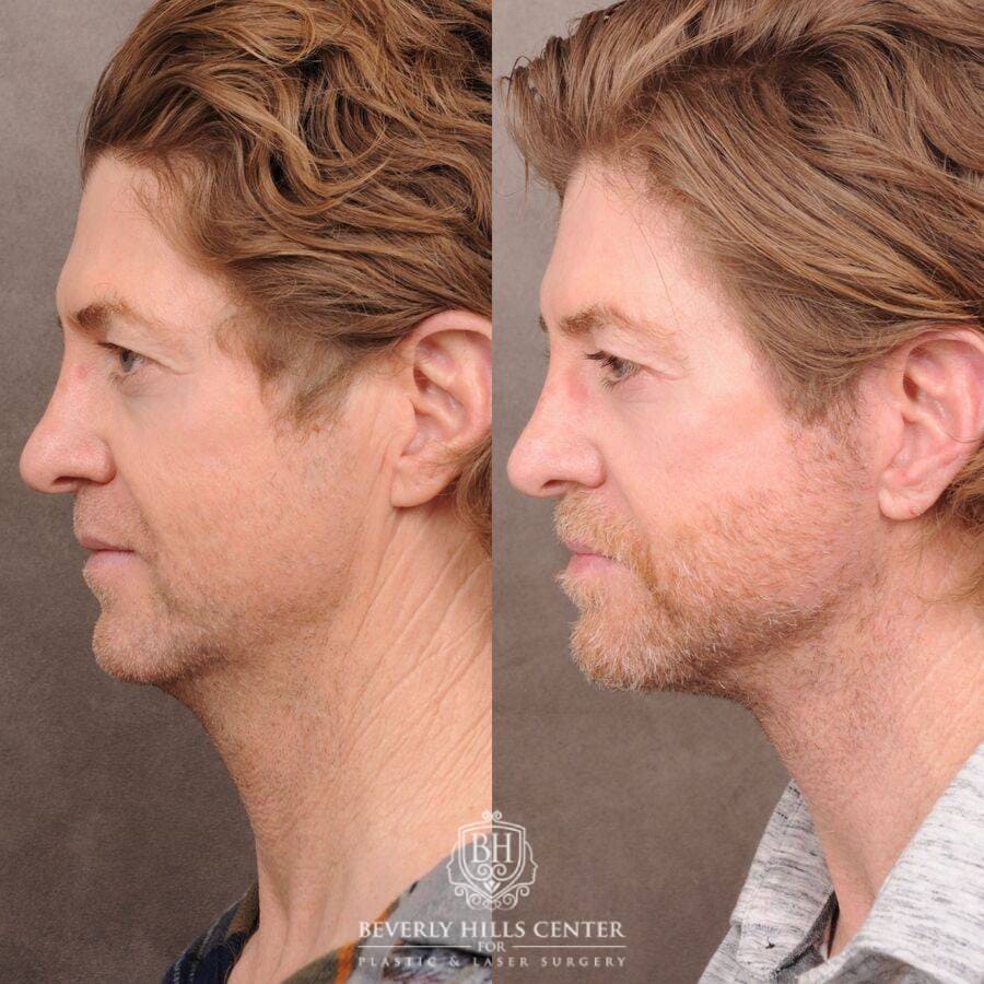 Beverly Hills Center Male Patient Before and After AuraLyft, Laryngeal Setback