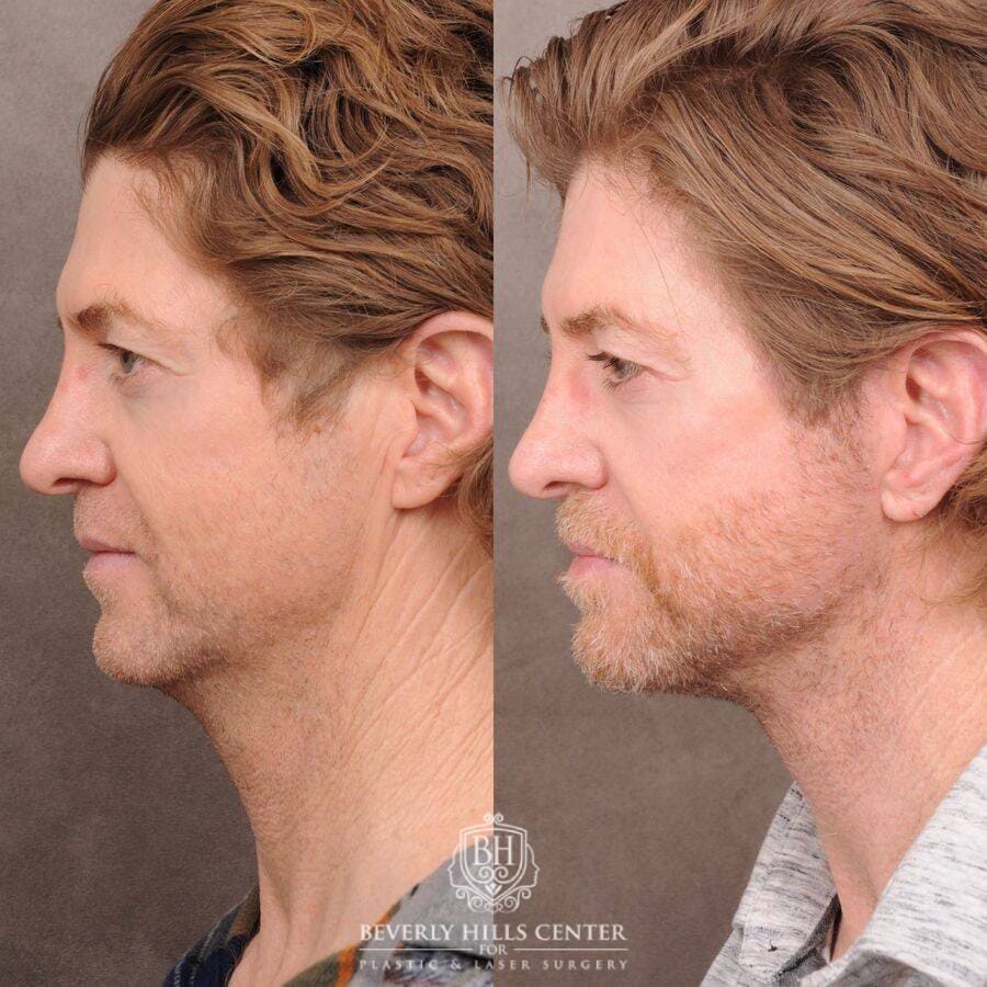 How to Get a Better Jawline - Procedures for a Chiseled Jaw