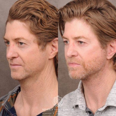 Beverly Hills Center Male Patient Before and After AuraLyft, Laryngeal Setback