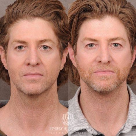 Beverly Hills Center Male Patient Before and After AuraLyft, Laryngeal Setback
