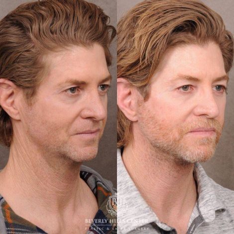 Beverly Hills Center Male Patient Before and After AuraLyft, Laryngeal Setback