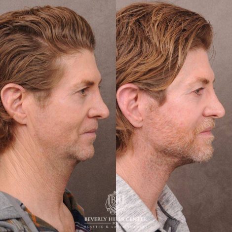 Beverly Hills Center Male Patient Before and After AuraLyft, Laryngeal Setback