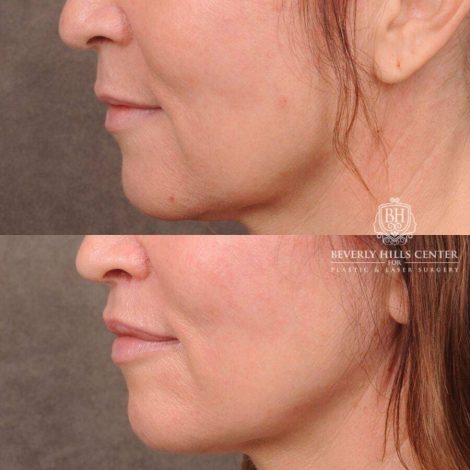 Beverly Hills Center Female Patient Before and After CUPID LIFT® Lip Lift